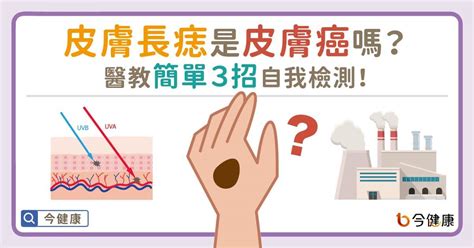 老二長痣|皮膚長痣是皮膚癌嗎？常見症狀，簡單3招自我檢測｜元氣